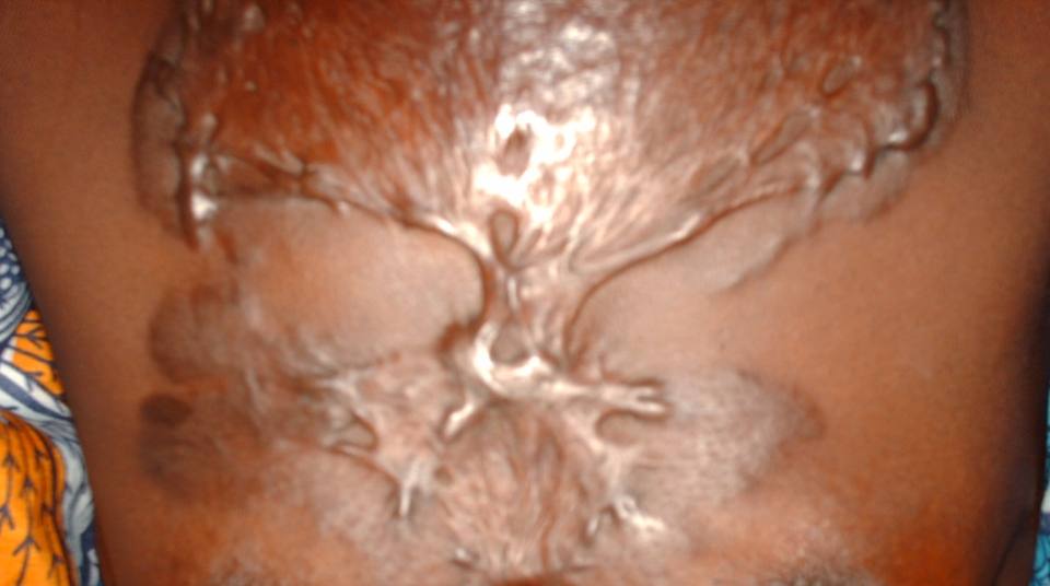 Photo médicale : Chéloïde